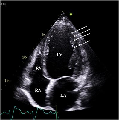 Tricuspid Annular Abnormalities in Isolated Left Ventricular Non-compaction—Insights From the Three-dimensional Speckle-Tracking Echocardiographic MAGYAR-Path Study